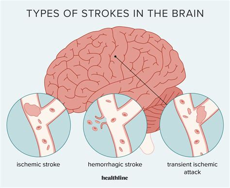 Stroke image. Things To Know About Stroke image. 
